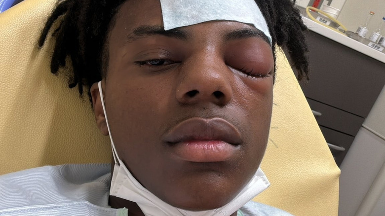 Speed lying in a hospital bed with swollen eyes caused by a sinus infection